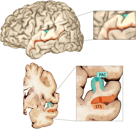 Auditory cortex stimulation improves speech perception over background noise