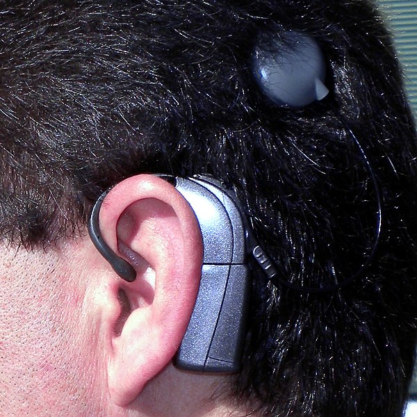 Cognitive functioning improves after cochlear implant in older adults