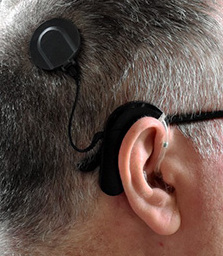 Bionic Hearing–When is it time to get a cochlear implant?